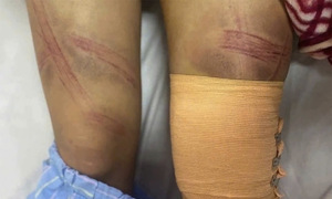 12-year-old girl hospitalized after being beaten by father