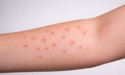 Signs of lung damage visible on skin and hands