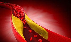 Why high cholesterol persists despite gym workouts?