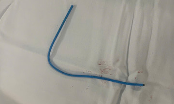 Chemotherapy catheter breaks, drifts into patient's heart