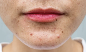 Five facial signs that may indicate fatty liver disease