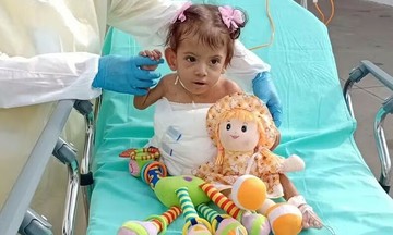 Conjoined twin dies 7 months after separation efforts
