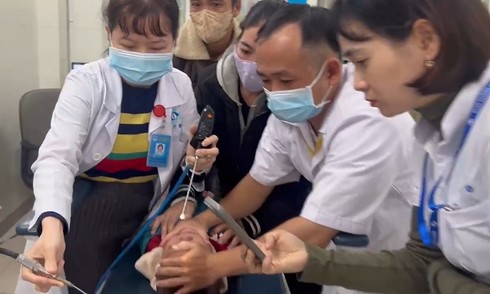 Parasitic leech removed from 2.5-year-old boy's nose after a week