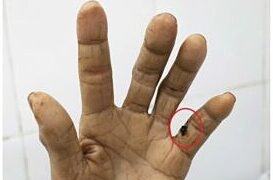 Minor wound leads to tetanus infection in woman