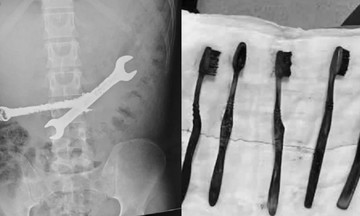 Doctors remove two iron wrenches and seven toothbrushes from young man's stomach