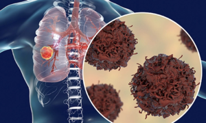 Self-discovery of neck lump leads to metastatic lung cancer diagnosis