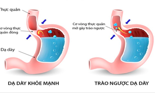 Who is susceptible to gastroesophageal reflux disease?
