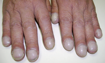 What do your fingernails reveal about your health?