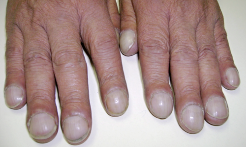 What do your fingernails reveal about your health?