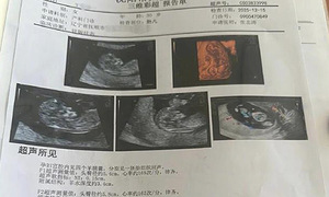 A woman carries quadruplets: a one in 15 million case