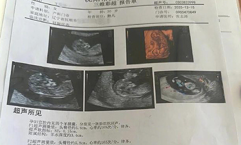 A woman carries quadruplets: a one in 15 million case