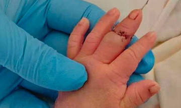 Midwife severs newborn's finger while cutting umbilical cord