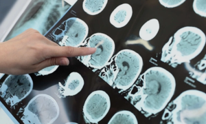 Heat shocks trigger stroke in cold weather