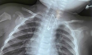 Safety pin lodged in 7-month-old baby's esophagus
