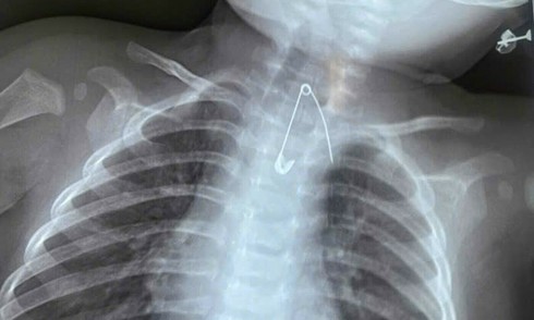 Safety pin lodged in 7-month-old baby's esophagus