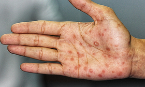 Is a rash after sexual intercourse syphilis?