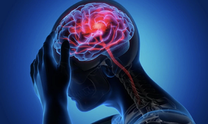 Three highest-risk times for stroke