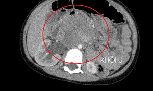 three-year-old boy diagnosed with testicular cancer