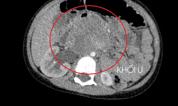 three-year-old boy diagnosed with testicular cancer