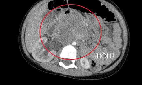 three-year-old boy diagnosed with testicular cancer