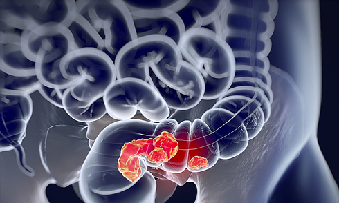diagnosed with two types of gastrointestinal cancer