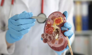 Doctors warn common habit silently harms kidneys
