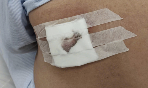 Back necrosis, critical due to applying leaves to treat boils