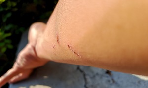 Why do rabies patients remain conscious?