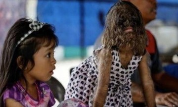 A new chapter in the life of the 'werewolf' girl