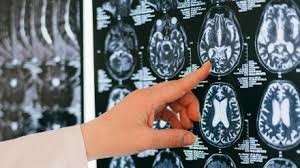 Cold mornings, warm afternoons weather triggers strokes