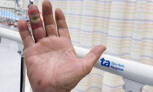 Dog bite wound reveals underlying diabetes after infection