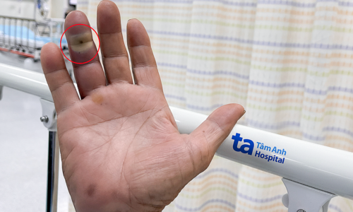 Dog bite wound reveals underlying diabetes after infection