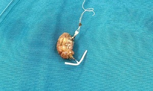 Intrauterine device migrates into bladder after 22 years