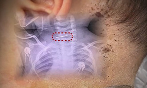 Mother stabs 10-month-old baby with hundreds of needles for treatment