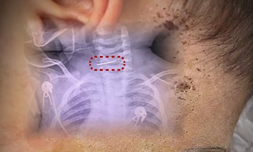 Mother stabs 10-month-old baby with hundreds of needles for treatment