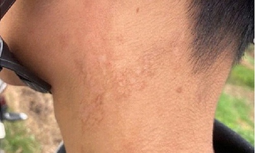 Itching year-round, examination reveals dog tapeworm infection