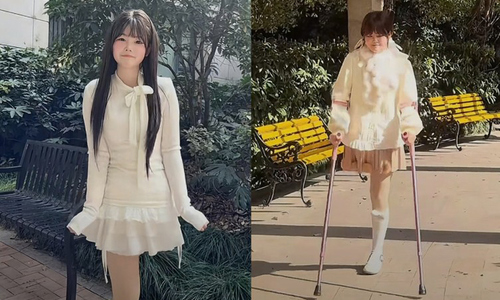 Young woman with bone cancer abandoned by family, signs surgical consent herself