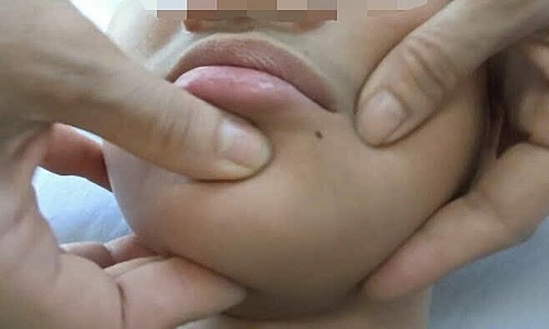 Many experience facial paralysis, drooping due to severe cold