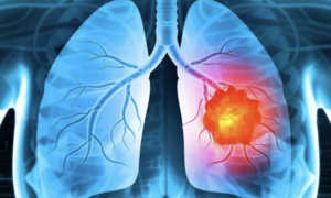 Doctor points out five easily ignored warning signs of lung cancer
