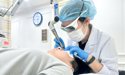 Subcision combined with laser treats acne scars