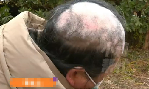 Abandoned by husband due to rare disease causing hair loss