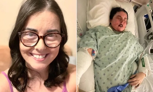 Single mother left blind, skin necrotic after drug reaction