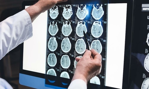 Is sudden headache a sign of stroke?