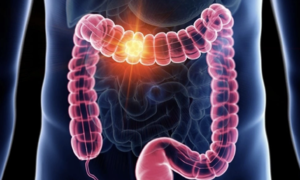 8 early warning signs of colorectal cancer often overlooked