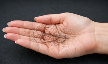 Causes of significant hair loss in women