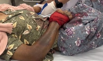 Elderly woman in critical condition after folk remedy for snakebite