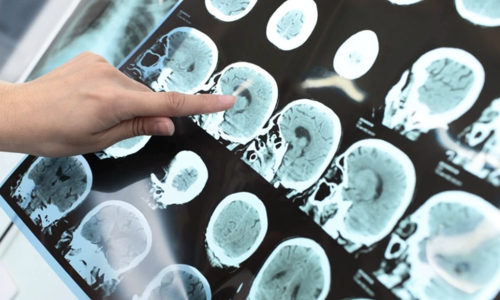 Believed it was common fatigue, but it was a stroke