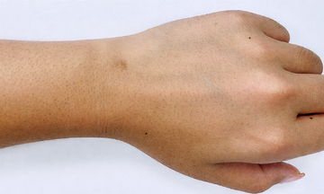 5 common hereditary cancers