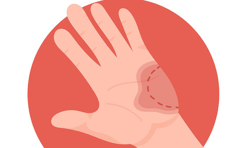 Bitten by a person at risk of rabies, can I get infected?