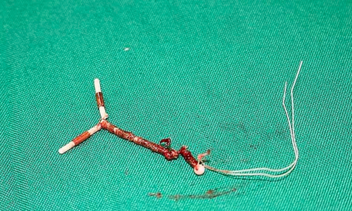 Forcing a partner into contraception or sterilization due to gender bias incurs penalties of up to 12 million dong